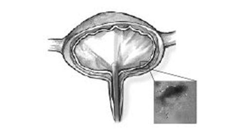 hlp_IC_Bladder